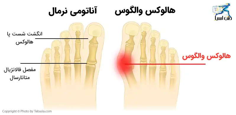 انحراف استخوان شست پا یا هالوکس والگوس طب آسیا