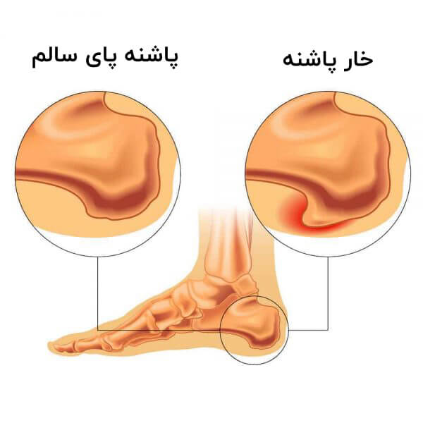 خارپاشنه